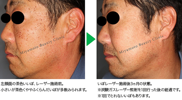 イボ 顔 取り 費用 の